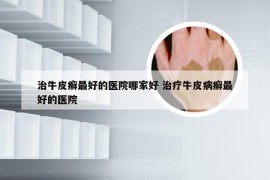治牛皮癣最好的医院哪家好 治疗牛皮病癣最好的医院