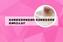 耳朵眼里容易得银屑病吗 耳朵眼里容易得银屑病吗怎么治疗