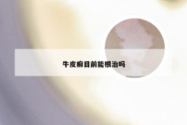 牛皮癣目前能根治吗
