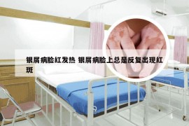 银屑病脸红发热 银屑病脸上总是反复出现红斑