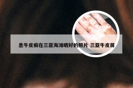 患牛皮癣在三亚海滩晒好的照片 三亚牛皮屑