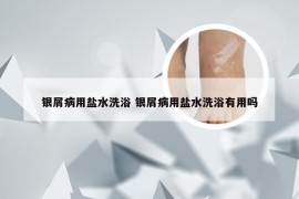 银屑病用盐水洗浴 银屑病用盐水洗浴有用吗