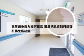 银屑病免疫力如何提高 银屑病患者如何增强机体免疫功能