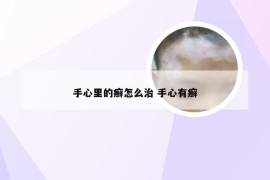 手心里的癣怎么治 手心有癣