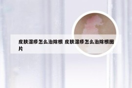 皮肤湿疹怎么治除根 皮肤湿疹怎么治除根图片