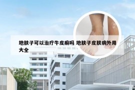 地肤子可以治疗牛皮癣吗 地肤子皮肤病外用大全