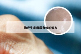 治疗牛皮癣最有效的偏方