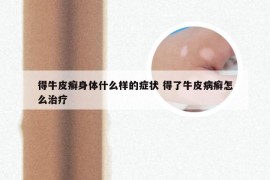 得牛皮癣身体什么样的症状 得了牛皮病癣怎么治疗