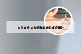 太阳光癣 太阳癣和日光性皮炎图片