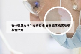 吉林哪里治疗牛皮癣权威 吉林银屑病医院哪家治疗好