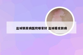 盐城银屑病医院哪家好 盐城看皮肤病