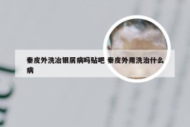 秦皮外洗冶银屑病吗贴吧 秦皮外用洗治什么病