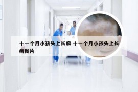 十一个月小孩头上长癣 十一个月小孩头上长癣图片