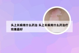 头上长癣用什么药治 头上长癣用什么药治疗效果最好