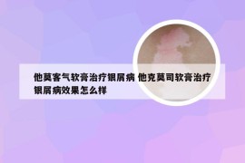 他莫客气软膏治疗银屑病 他克莫司软膏治疗银屑病效果怎么样