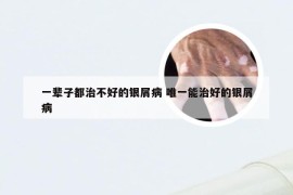 一辈子都治不好的银屑病 唯一能治好的银屑病