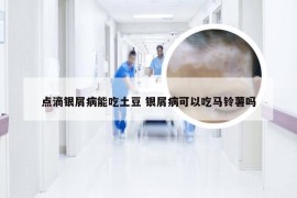 点滴银屑病能吃土豆 银屑病可以吃马铃薯吗