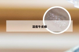 湿度牛皮癣