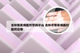 吉林银屑病医院赞扬华山 吉林市银屑病最好医院在哪