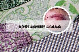 义乌看牛皮癣哪里好 义乌皮肤病