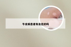 牛皮癣患者有自愈的吗