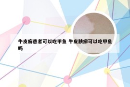 牛皮癣患者可以吃甲鱼 牛皮肤癣可以吃甲鱼吗