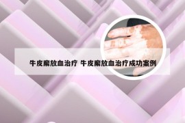 牛皮廨放血治疗 牛皮廨放血治疗成功案例