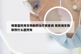 哪里医院用生物制剂治疗银屑病 银屑病生物制剂什么医院有