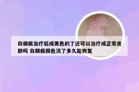 白癫疯治疗后成黑色的了还可以治疗成正常皮肤吗 白颠疯颜色淡了多久能恢复