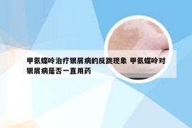 甲氨蝶呤治疗银屑病的反跳现象 甲氨蝶呤对银屑病是否一直用药