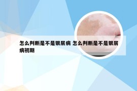 怎么判断是不是银屑病 怎么判断是不是银屑病初期