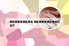 哺乳期银屑病能用啥 哺乳期银屑病能用啥药治疗