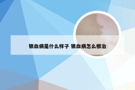 银血病是什么样子 银血病怎么根治