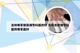 吉林哪家银屑病专科医院好 吉林皮肤病专科医院哪家最好