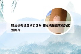 硬皮病和银屑病的区别 硬皮病和银屑病的区别图片