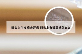 额头上牛皮癣会好吗 额头上有银屑病怎么办
