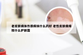 老皮肤病体热很痒抹什么药好 老性皮肤瘙痒擦什么护肤霜