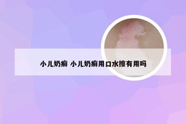 小儿奶癣 小儿奶癣用口水擦有用吗