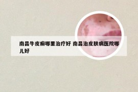 南昌牛皮癣哪里治疗好 南昌治皮肤病医院哪儿好
