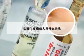 头部牛皮癣病人用什么洗头