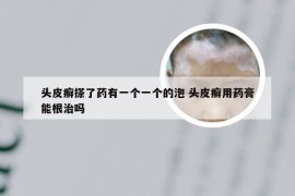 头皮癣搽了药有一个一个的泡 头皮癣用药膏能根治吗
