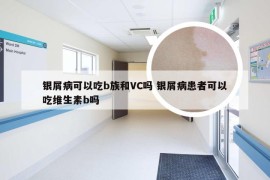 银屑病可以吃b族和VC吗 银屑病患者可以吃维生素b吗