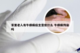 家里老人有牛癖癣应主意些什么 牛癖癣传染吗