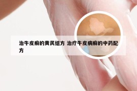 治牛皮癣的黄芪组方 治疗牛皮病癣的中药配方