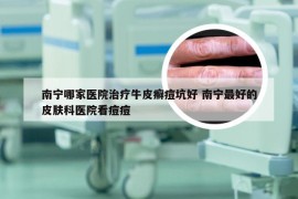 南宁哪家医院治疗牛皮癣痘坑好 南宁最好的皮肤科医院看痘痘