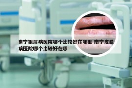 南宁银屑病医院哪个比较好在哪里 南宁皮肤病医院哪个比较好在哪