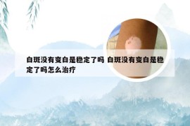 白斑没有变白是稳定了吗 白斑没有变白是稳定了吗怎么治疗