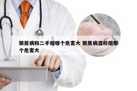 银屑病和二手烟哪个危害大 银屑病酒和烟那个危害大