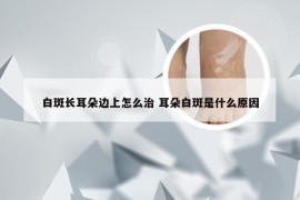 白斑长耳朵边上怎么治 耳朵白斑是什么原因