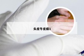 头皮牛皮癣1